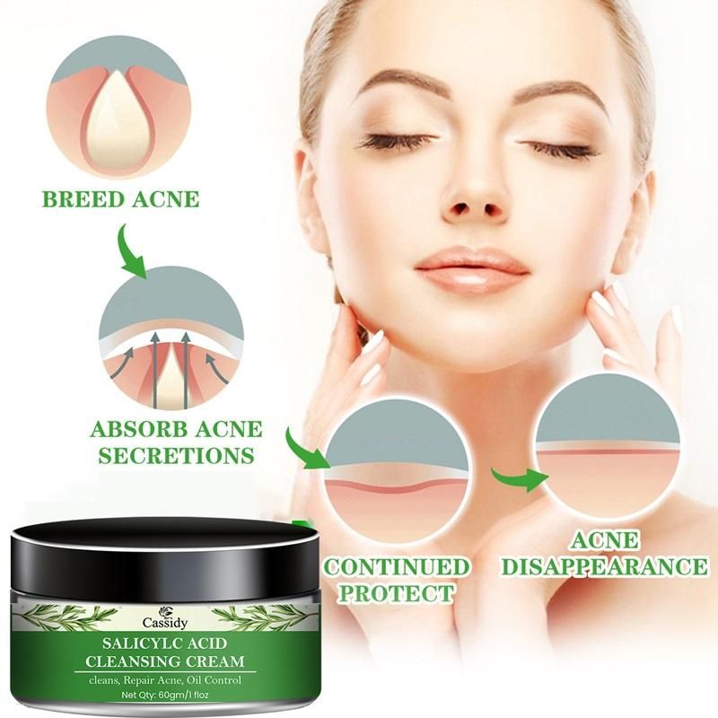CASSIDY Salicylc Acid Cleansing Cream, 60gm (Pack Of 1) : DRC